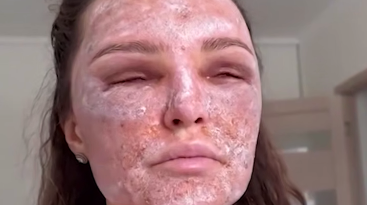 Красота с риском: как лазерная шлифовка лица калечит кожу