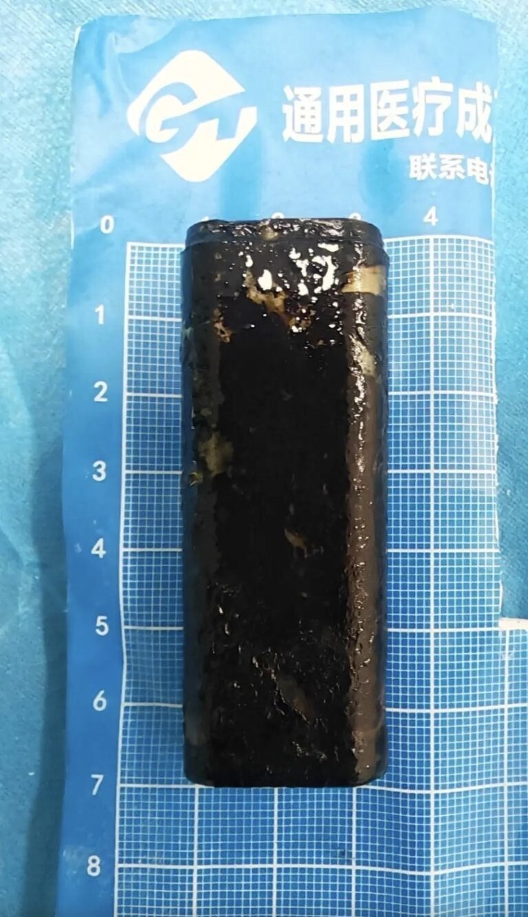 Врачи извлекли зажигалку из желудка мужчины, который в пьяном угаре проглотил её 30 лет назад