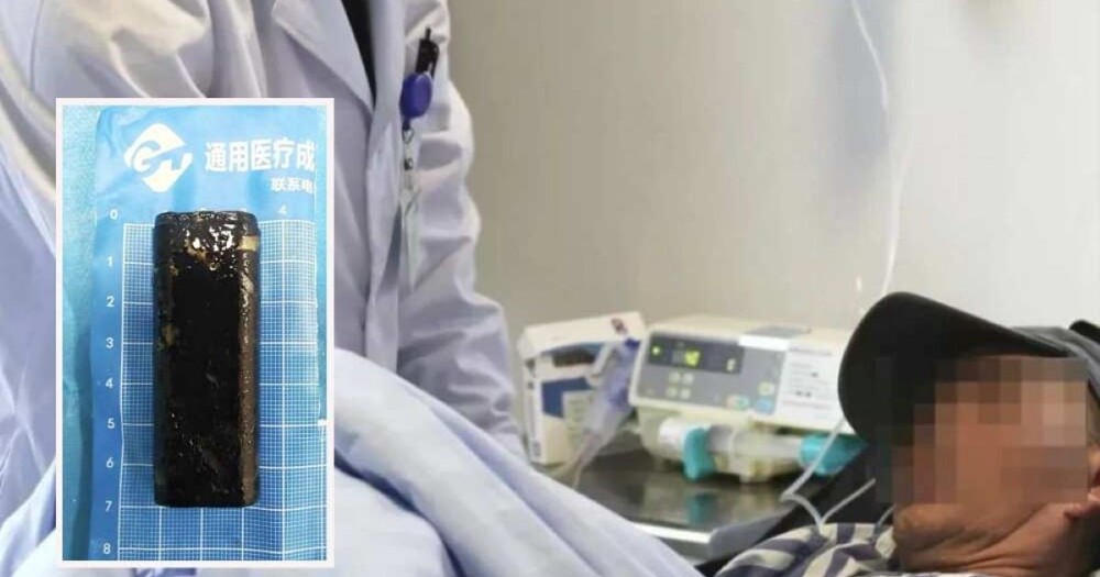 Врачи извлекли зажигалку из желудка мужчины, который в пьяном угаре проглотил её 30 лет назад