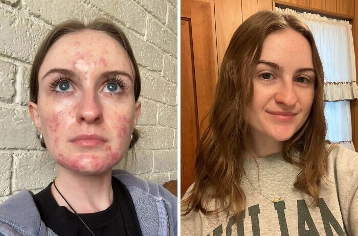 20. Один год лечения третиноином. Я счастлива и довольна результатами