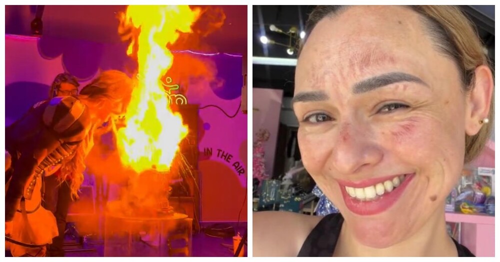 Девушка получила сильные ожоги лица на дне рождения