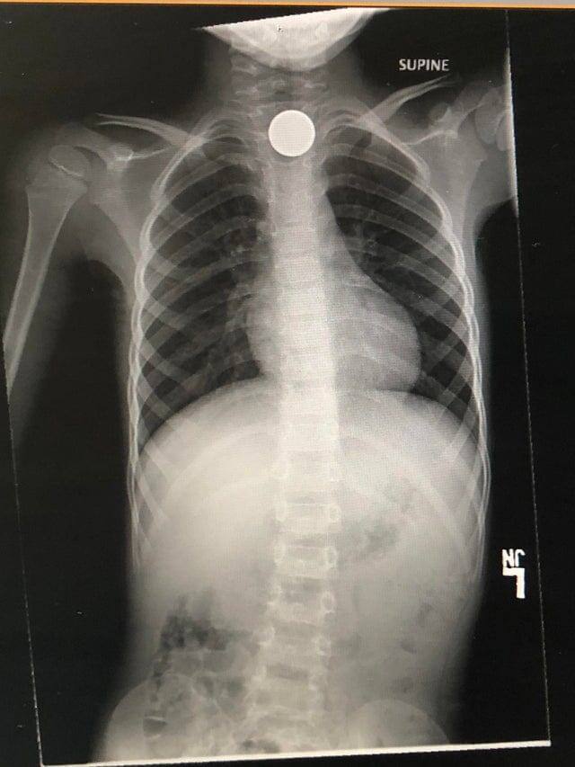 2. Мой сын решил проглотить монетку и превратил её в огромный счёт от врача