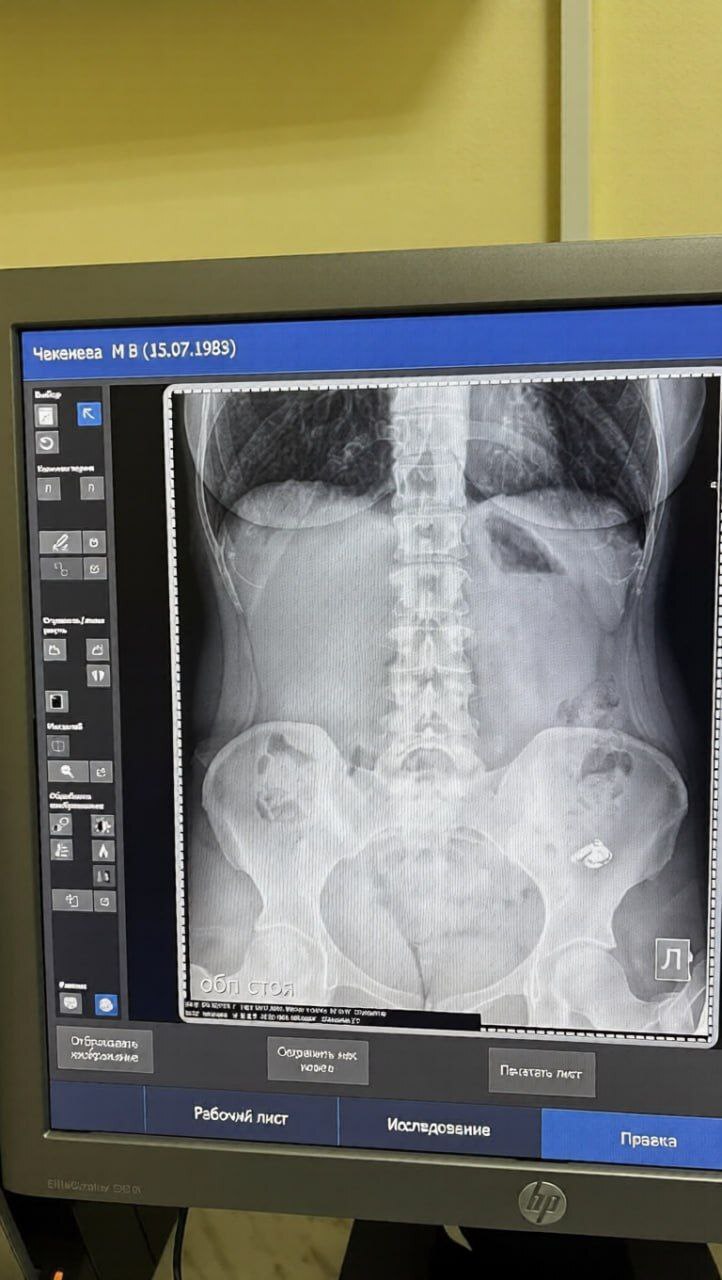 Жительница Уфы по ошибке проглотила наушник, приняв его за таблетку