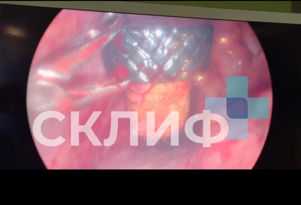 Как обычная прогулка в лесу закончилась «вскрытием» легких из-за пробки от коньяка