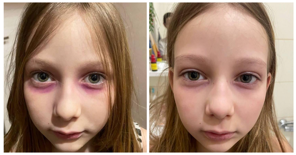 Женщина неделю лечила 10-летнюю дочь от редкой болезни, которую та нарисовала себе под глазами