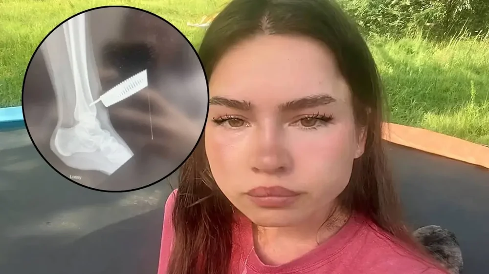 Девушка с пружиной от батута в ноге первым делом решила снять видео для TikTok
