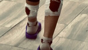 В Ивановской области покусанной собаками девочке не смогли оказать медицинскую помощь