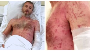 Неосторожный мужчина оказался в больнице после встречи с борщевиком
