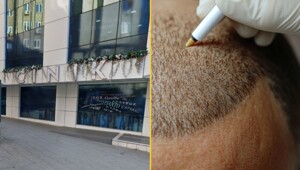 Британец умер во время пересадки волос в Турции