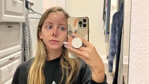 Женщине потребовалось 16 операций, чтобы восстановить нос после укуса собаки