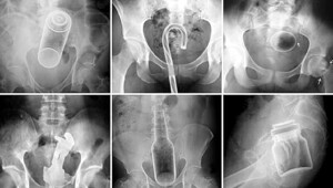 Эксперты составили рейтинг вещей, которые застревали в разных отверстиях людей в 2025 году