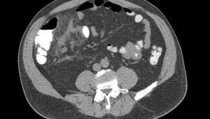 Острый аппендицит при весе 160 кг 