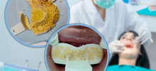 Китаянка чуть не задохнулась, пытаясь сэкономить на стоматологе