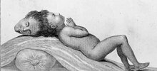 Бенгальский мальчик – один из первых зафиксированных случаев паразитарных краниопагов