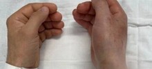 В России впервые провели успешную операцию по пересадке рук