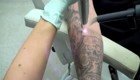 Исправление ошибок молодости: как лазером удаляют татуировки 