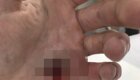 Хирург промывает простреленную насквозь ладонь