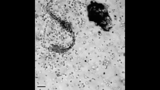 Как лейкоциты атакуют червя-паразита