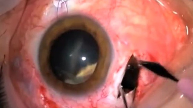 Удаление стекла из глазного яблока