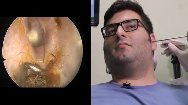 Чистка ушей людям, которые очень давно не делали этого сами