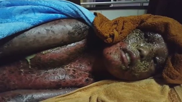 Заболевание кожи у ребёнка