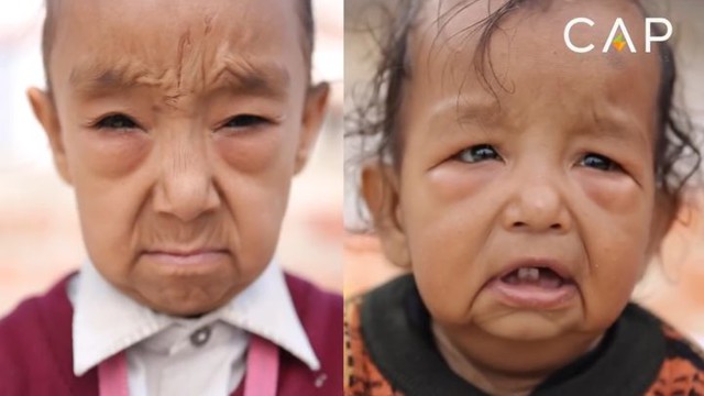 Болезнь превратила детей в стариков