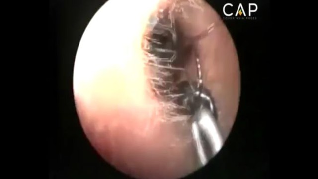 Врачи обнаружили в ухе девочки гнездо муравьев