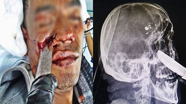 Удаление ножа из головы