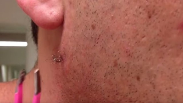 Удаление гигантского вросшего волоса