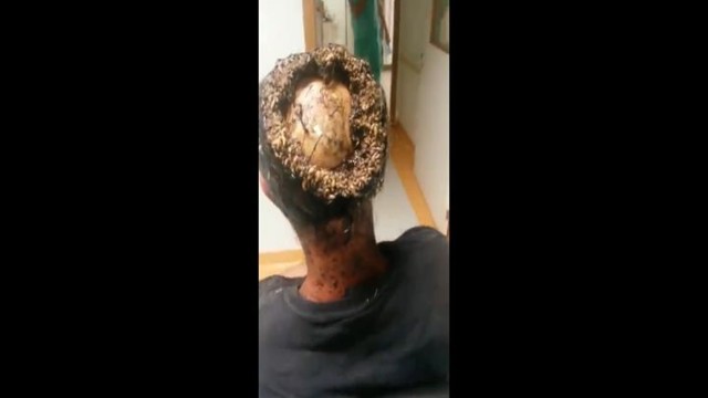 В бразильскую больницу пришёл пациент с раной, прогнившей до черепа