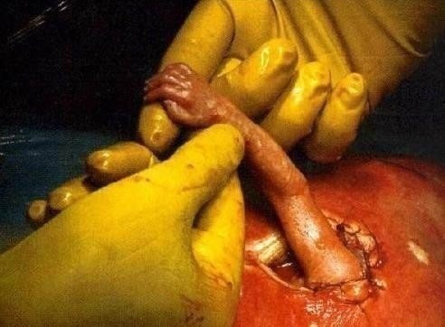 Операция  нерождённого  малыша
