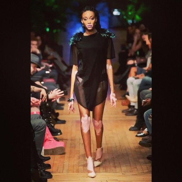 Американская модель с нарушением пигментации кожи