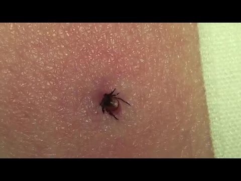 Как вытащить клеща