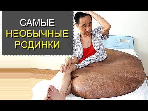 Самые необычные родинки