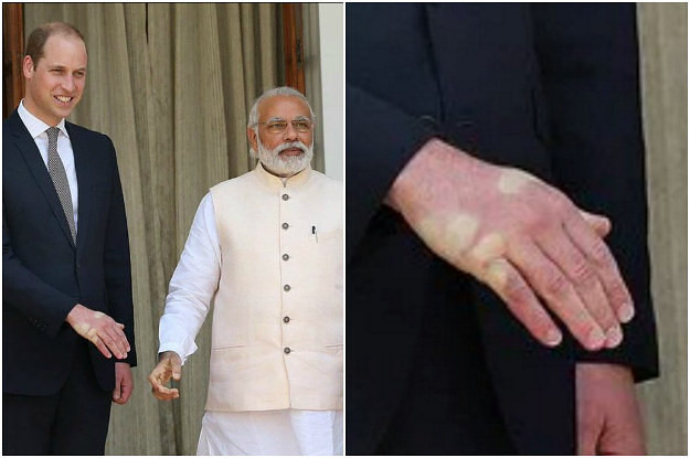 После обмена рукопожатиями с лидером Индии Нарендрой Моди рука принца Уильяма выглядит просто кошмарно!