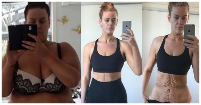 25-летняя девушка, похудевшая на 92 кг, показала результаты борьбы с обвисшей кожей