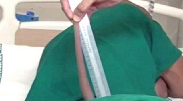 Индийские хирурги удалили парню 18-сантиметровый хвост