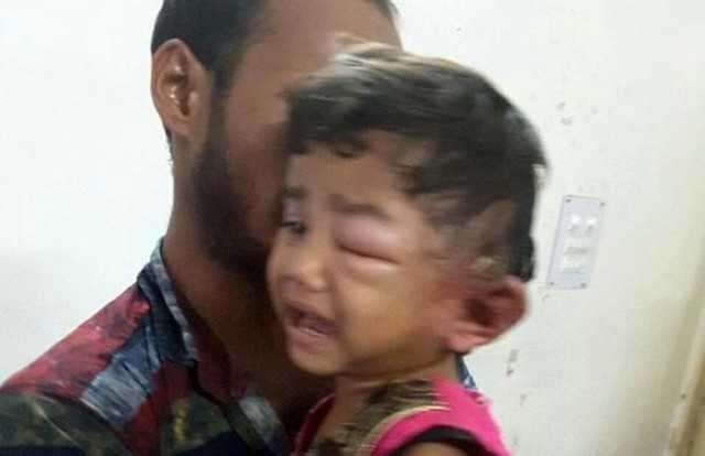 У четырехлетней девочки врачи извлекли из уха 80 личинок