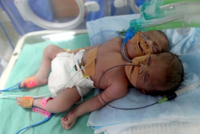 Двухголовый ребенок родился в Палестине