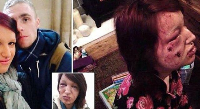 Ревнивый парень покусал лицо подруги, чтобы ни один мужик больше на нее не посмотрел