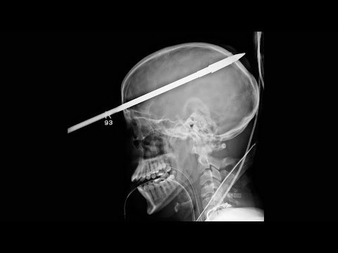 10 самых шокирующих рентген-снимков