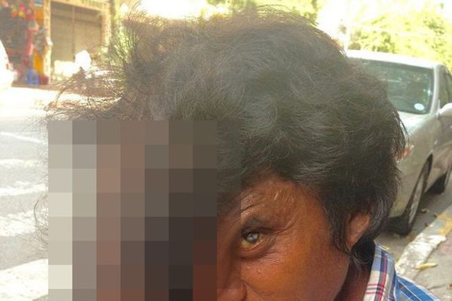 Мужчина из Камбоджи с огромным наростом на лице