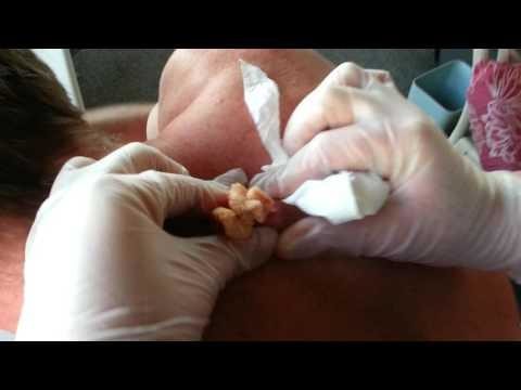 Удаление 30-летней кожной кисты