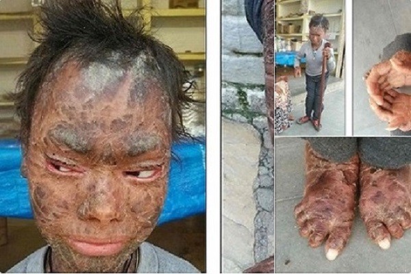 В Индии "девочка-змея" сбрасывает кожу каждые 45 дней