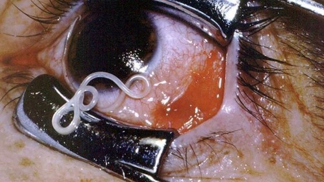 В глазном яблоке жительницы Индии нашли червя длиной семь сантиметров