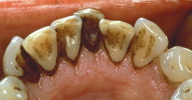 Как без помощи стоматолога можно удалить зубной налёт?
