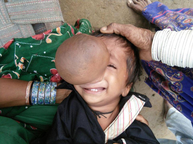 Пакистанский мальчик с  огромной опухолью на носу