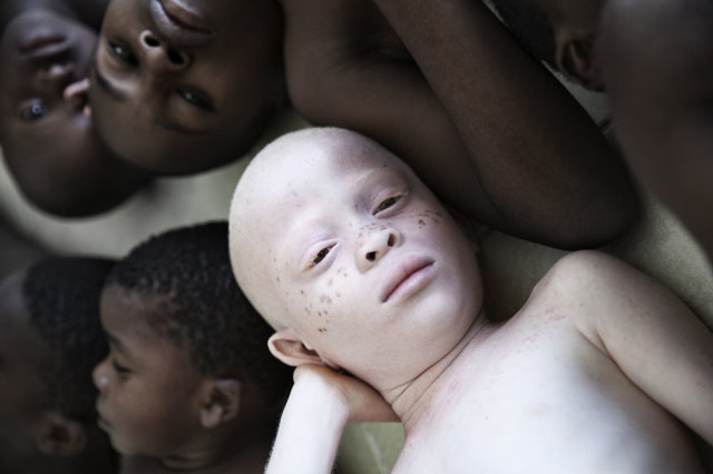 Удивительные портреты альбиносов Танзании, призывающие мир "проснуться"