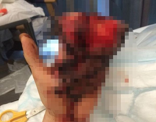 Хирурги спасли парню руку, зашив её в живот