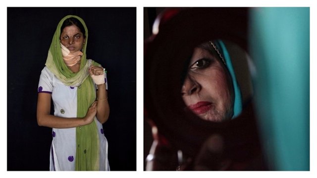 Жуткая фотовыставка: женщины, на которых напали и облили кислотой